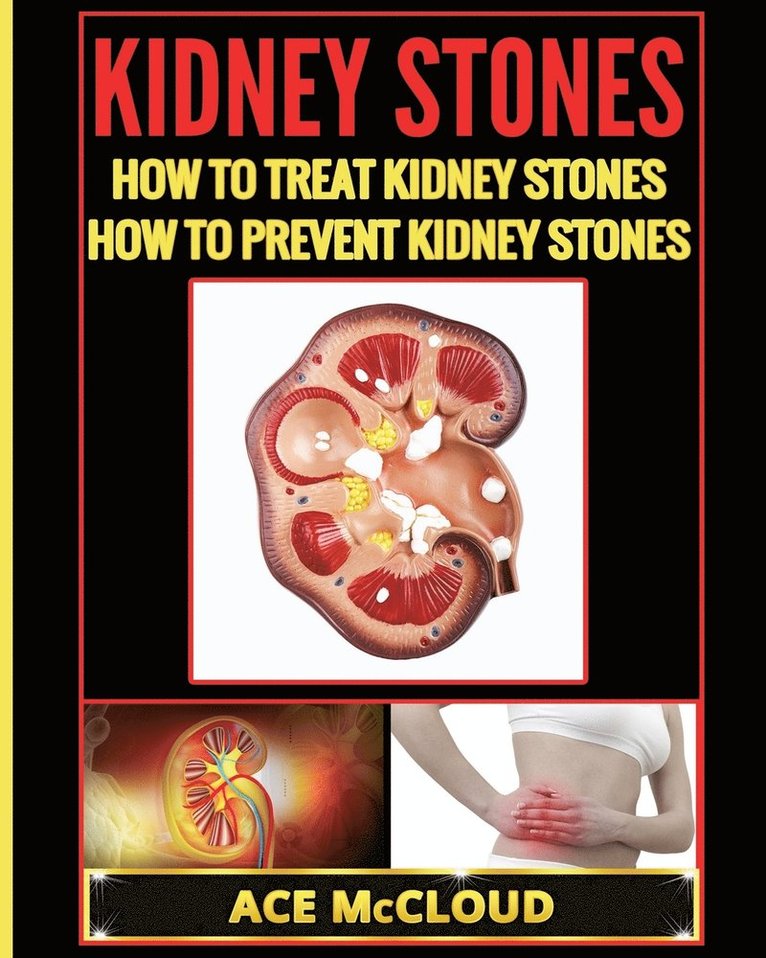 Kidney Stones 1