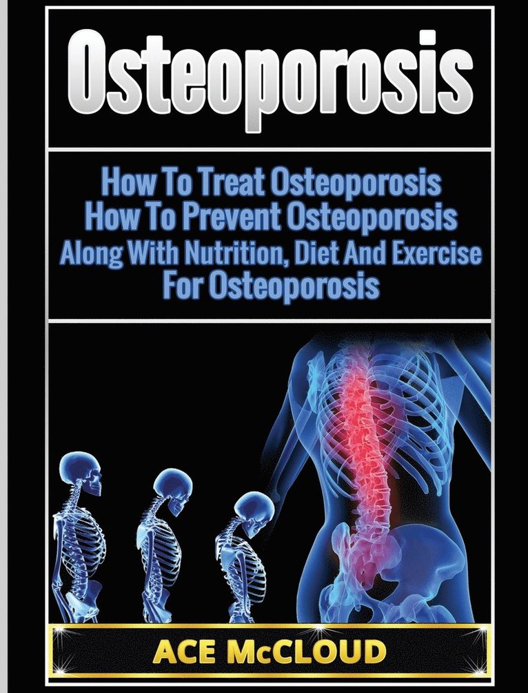 Osteoporosis 1