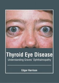 bokomslag Thyroid Eye Disease: Understanding Graves' Ophthalmopathy