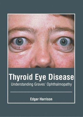 Thyroid Eye Disease: Understanding Graves' Ophthalmopathy 1