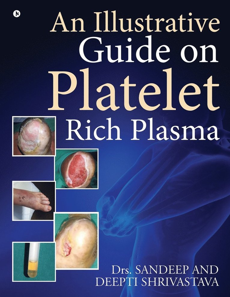 Illustrative Guide on Platelet Rich Plasma
