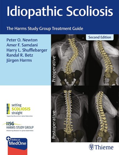 Peter Newton, Amer Samdani, Harry Shufflebarger, Randal Betz, Jürgen Harms - Idiopathic Scoliosis, Inbunden