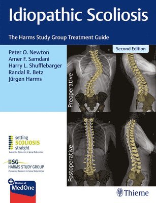 bokomslag Idiopathic Scoliosis