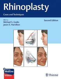 bokomslag Rhinoplasty: Cases and Techniques