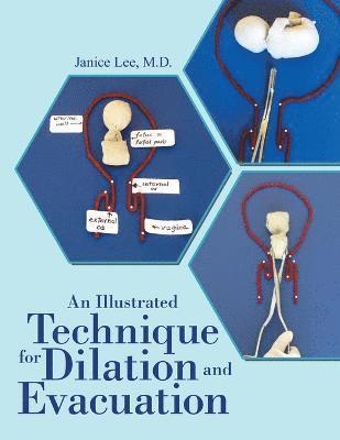 An Illustrated Technique for Dilation and Evacuation 1