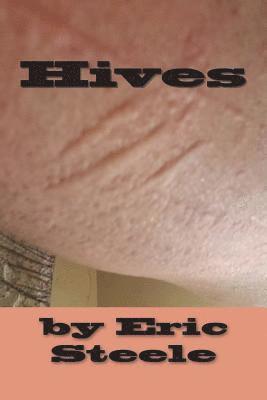 Hives 1