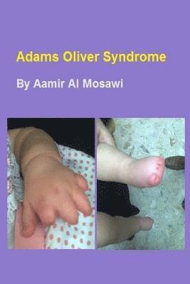 bokomslag Adams Oliver syndrome: Clinical genetics