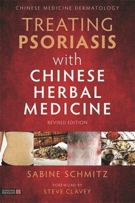 Sabine Schmitz - Treating Psoriasis with Chinese Herbal Medicine (Revised Edition), Häftad