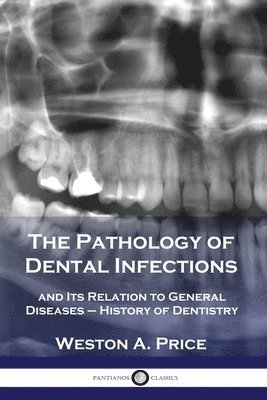 The Pathology of Dental Infections 1