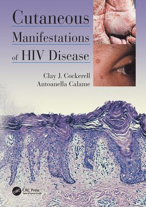 bokomslag Cutaneous Manifestations of HIV Disease