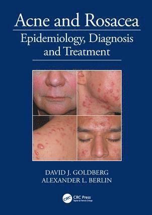 David Goldberg, Alexander Berlin - Acne and Rosacea, Inbunden