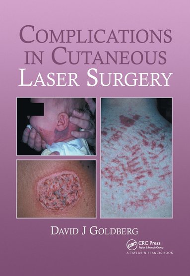 bokomslag Complications in Laser Cutaneous Surgery