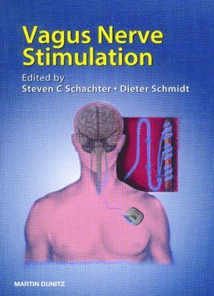 Vagus Nerve Stimulation 1