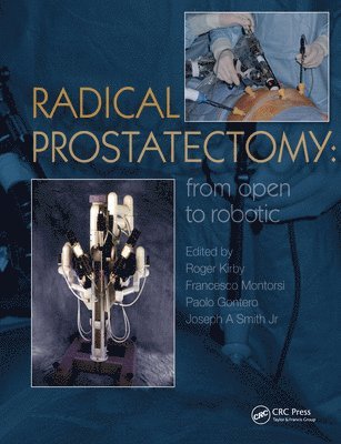 Radical Prostatectomy 1