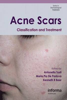 Acne Scars: Classification and Treatment