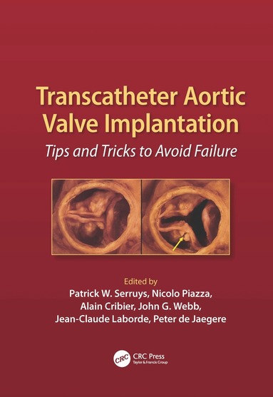 Patrick W. Serruys, Alain Cribier, John G. Webb - Transcatheter Aortic Valve Implantation, Inbunden