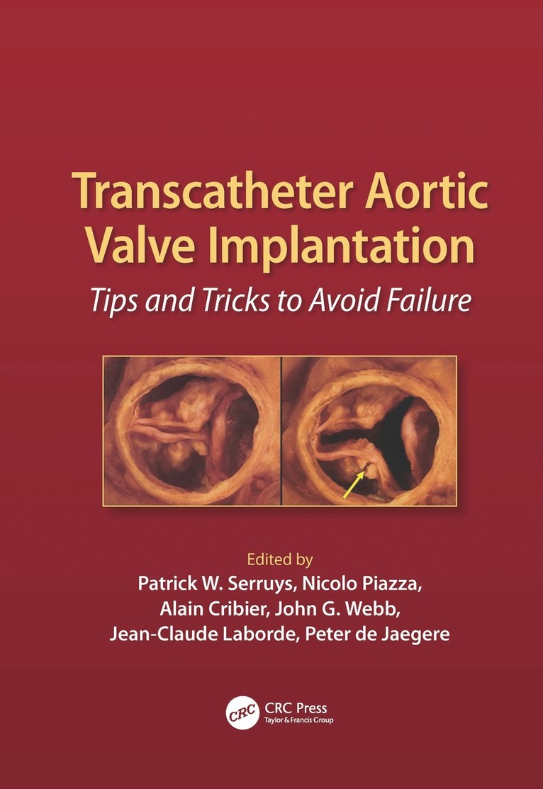 Patrick W. Serruys, Alain Cribier, John G. Webb, Rotterdam.) Serruys, Patrick W. (Interventional Dept, Heartcenter Rotterdam; Thoraxcenter, EMC, Rouen.) Cribier, Alain (UHC, Canada) Webb, John G. (St. Paul’s Hospital, Univ of British Columbia - Transcatheter Aortic Valve Implantation, Inbunden