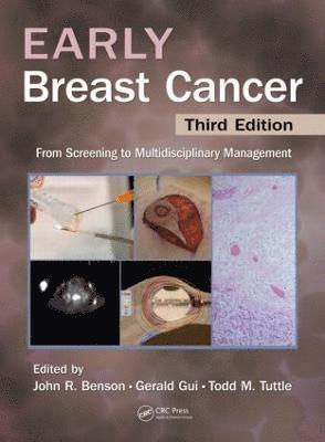 Early Breast Cancer 1