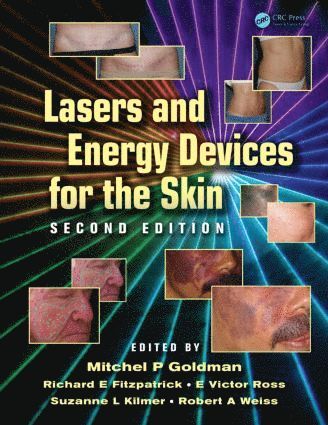 Mitchel P. Goldman, Richard E. Fitzpatrick, E. Victor Ross, Suzanne L. Kilmer, Robert A. Weiss - Lasers and Energy Devices for the Skin, Inbunden