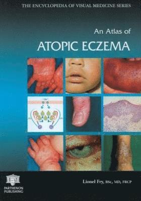 bokomslag Atlas of Atopic Eczema