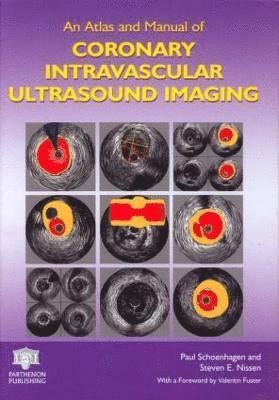 Paul Schoenhagen, Steven E. Nissen, USA) Schoenhagen, Paul (The Cleveland Clinic Foundation, Cleveland, Ohio, USA) Nissen, Steven E. (Cleveland Clinic Foundation, Cleveland, Ohio - Atlas and Manual of Coronary Intravascular Ultrasound Imaging, Inbunden
