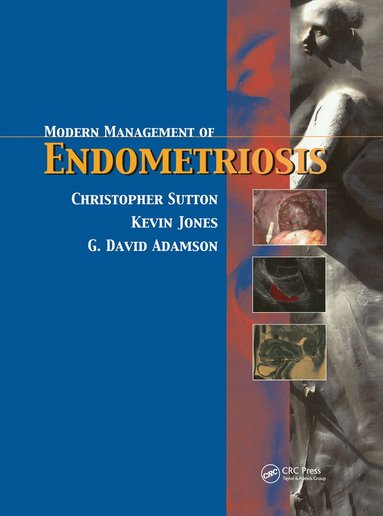 Christopher Sutton, G. David Adamson, Kevin D. Jones - Modern Management of Endometriosis, Inbunden