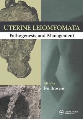 bokomslag Uterine Leiomyomas