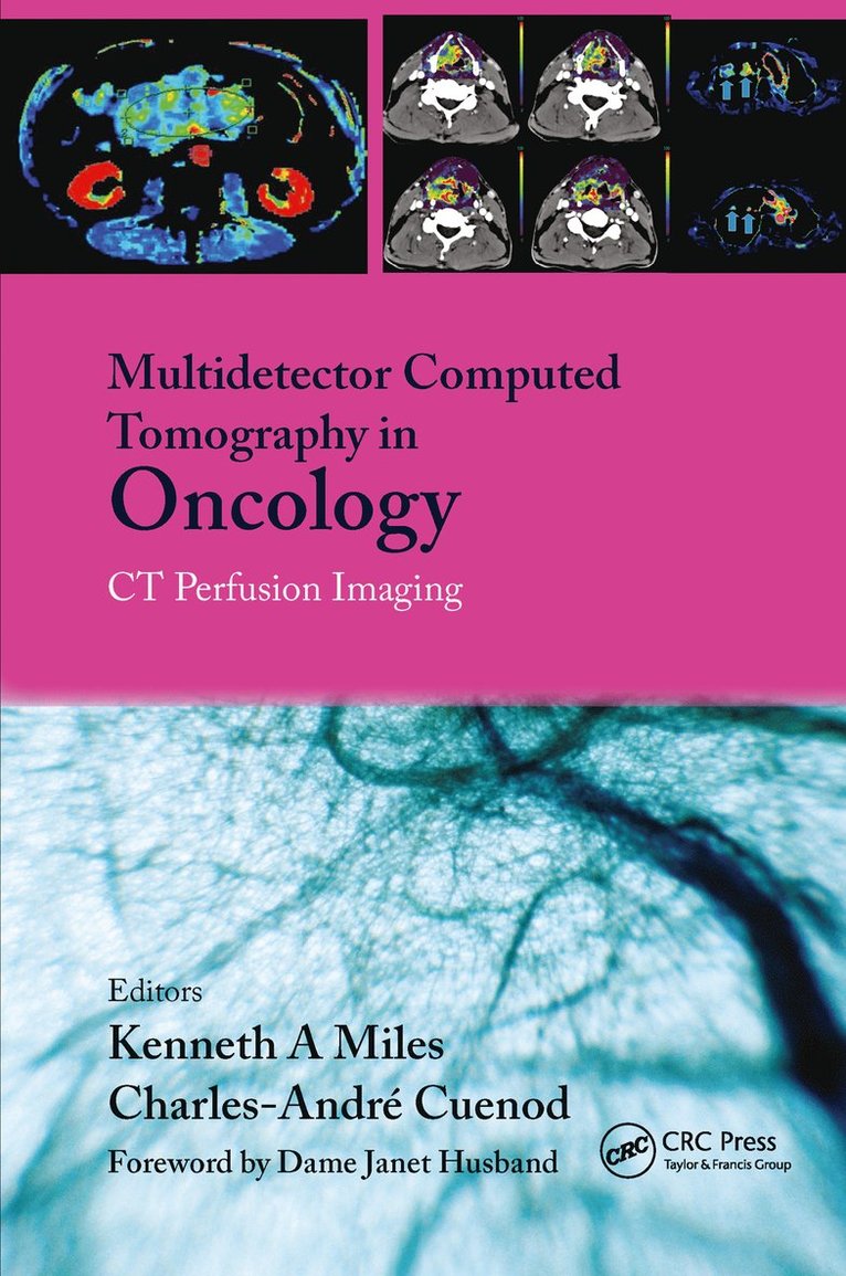 Multi-Detector Computed Tomography in Oncology