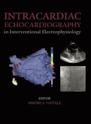 Andrea Natale, USA) Natale, Andrea, MD, FACC, FHRS (The Cleveland Clinic Heart Center, Cleveland, Ohio - Intracardiac Echocardiography in Interventional Electrophysiology, Inbunden
