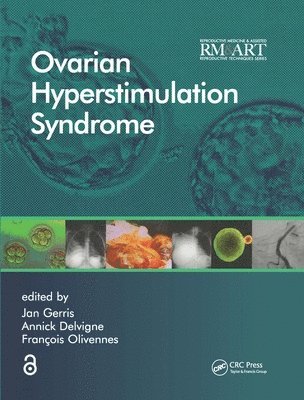 Ovarian Hyperstimulation Syndrome 1