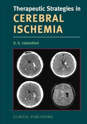 Cerebral Ischemia 1