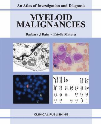 Myeloid Malignancies 1
