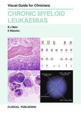 Chronic Myeloid Leukaemias 1