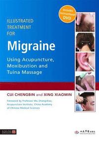 bokomslag Illustrated Treatment for Migraine Using Acupuncture, Moxibustion and Tuina Massage