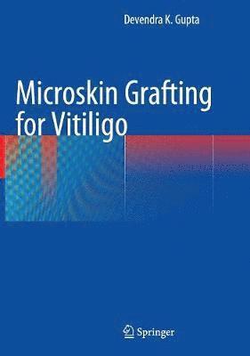 Devendra K. Gupta - Microskin Grafting for Vitiligo, Inbunden