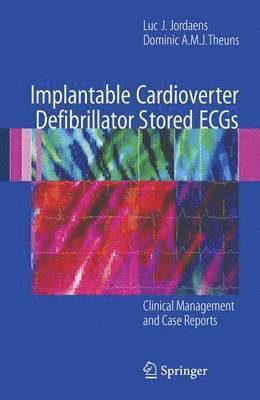 Implantable Cardioverter Defibrillator Stored ECGs 1