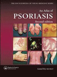 bokomslag Atlas of Psoriasis, An