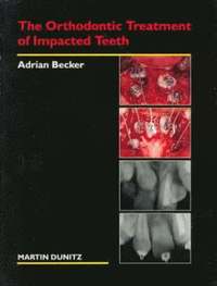 bokomslag The Orthodontic Treatment of Impacted Teeth