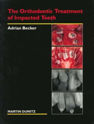 The Orthodontic Treatment of Impacted Teeth 1