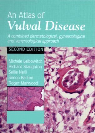 Michèle Leibowitch, Richard Staughton, Sallie Neill, Simon Barton, Roger Marwood - Atlas of Vulval Diseases, Inbunden