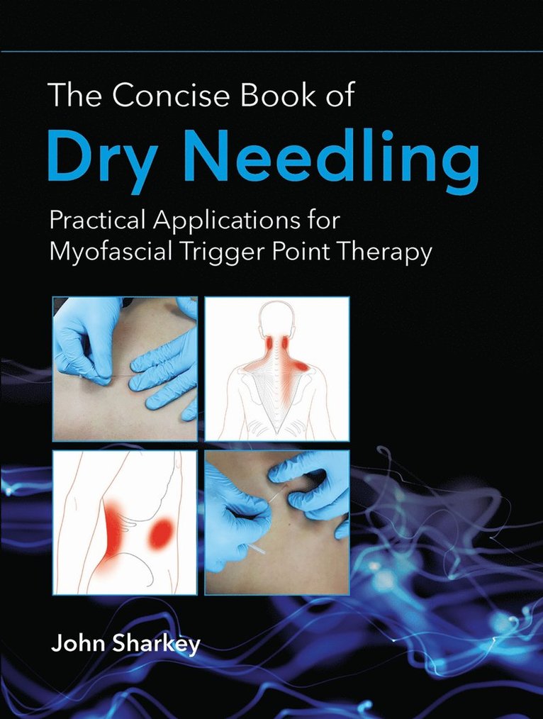 The Concise Book of Dry Needling 1