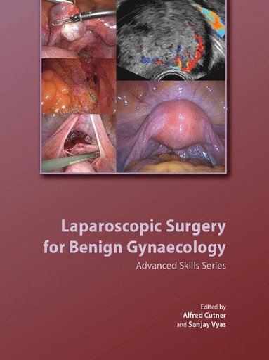 bokomslag Laparoscopic Surgery for Benign Gynaecology Hardback with DVDs