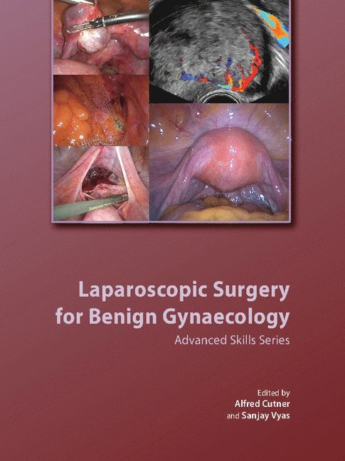 Laparoscopic Surgery for Benign Gynaecology Hardback with DVDs 1