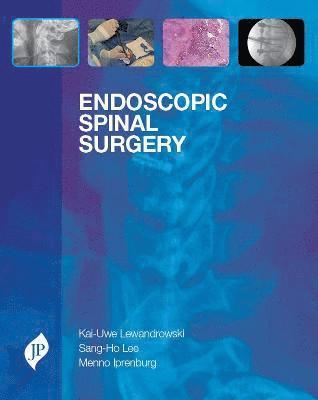 Endoscopic Spinal Surgery 1