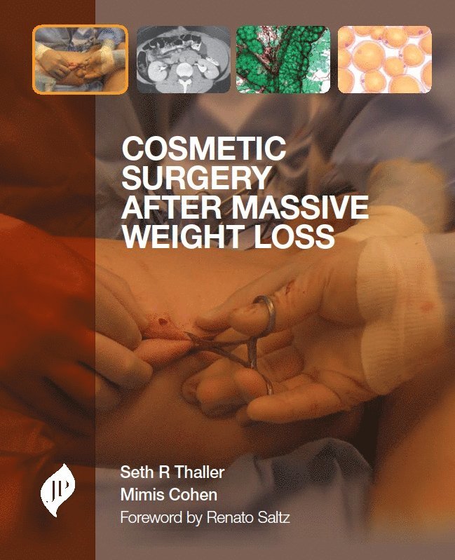 Seth Thaller, Mimis Cohen - Cosmetic Surgery after Massive Weight Loss, Inbunden