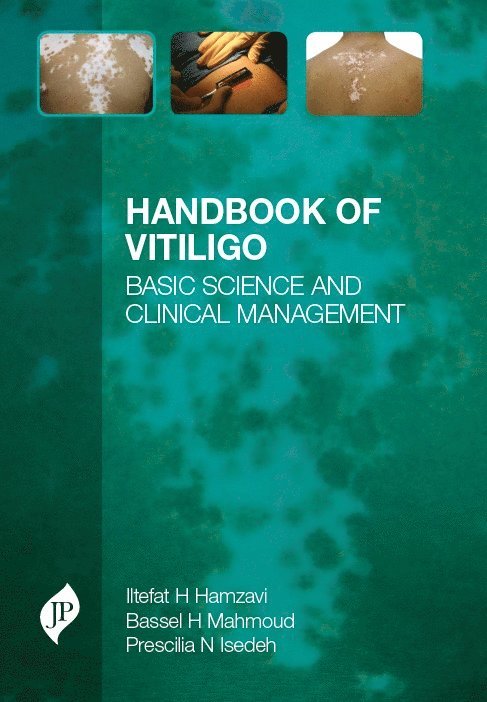 Iltefat Hamzavi, Bassel H. Mahmoud, Prescilia N. Isedeh - Handbook of Vitiligo, Inbunden