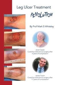bokomslag Leg Ulcer Treatment Revolution