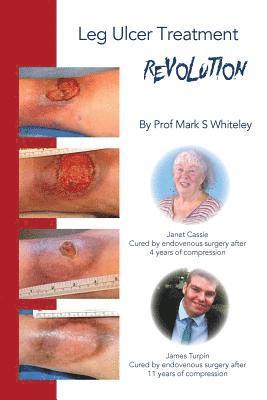 Leg Ulcer Treatment Revolution 1