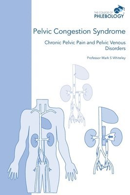 Pelvic Congestion Syndrome - Chronic Pelvic Pain and Pelvic Venous Disorders 1