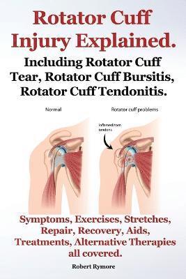 Rotator Cuff Injury Explained. Including Rotator Cuff Tear, Rotator Cuff Bursitis, Rotator Cuff Tendonitis. Symptoms, Exercises, Stretches, Repair, Recovery, Aids, Treatments, Alternative Therapies 1